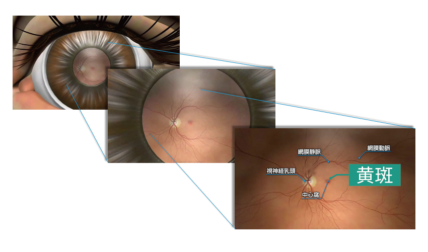 加齢黄斑変性イラスト1-1