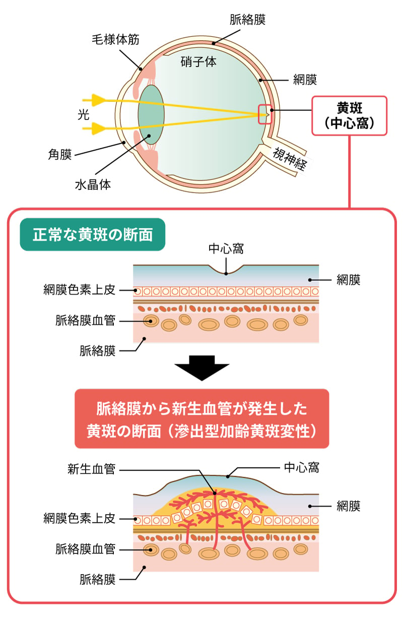 加齢黄斑変性の原因