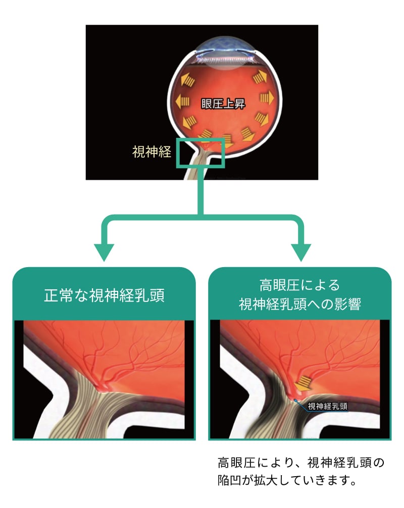 乳頭 陥没 視神経