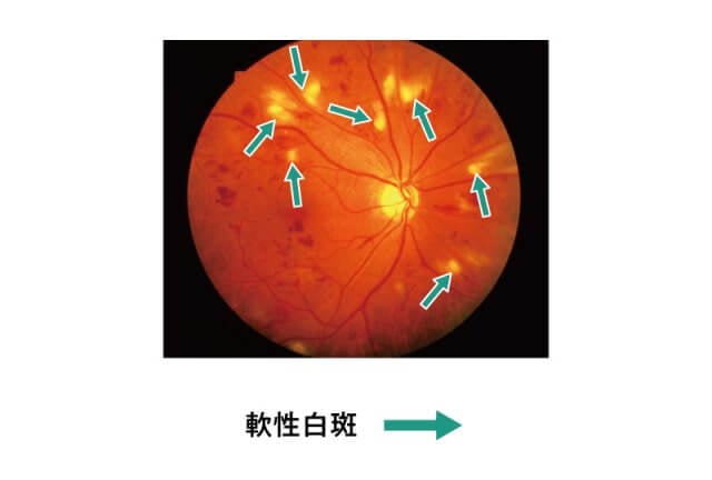 糖尿病糖尿病網膜症イラスト3