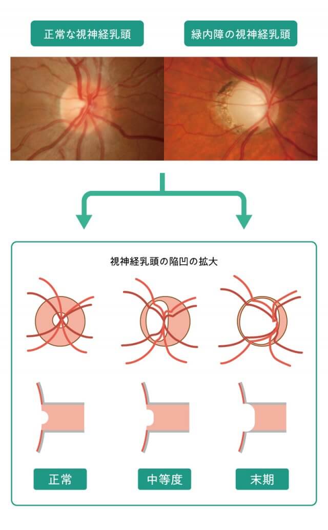 緑内障イラスト3