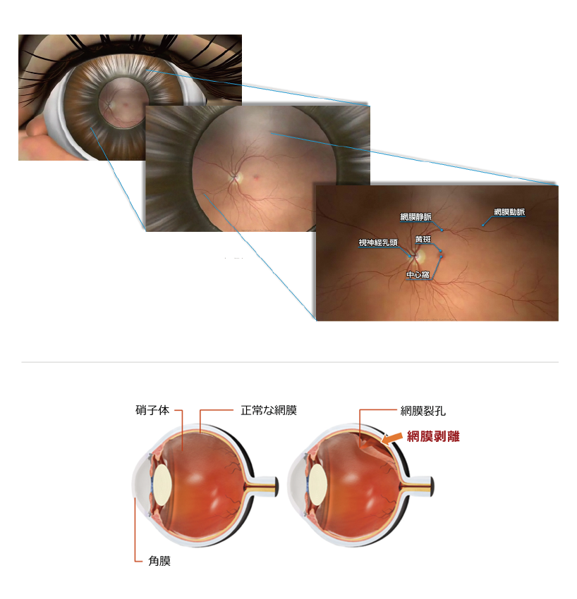 その他の網膜疾患イラスト1-1