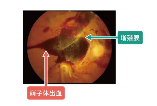 糖尿病糖尿病網膜症イラスト4