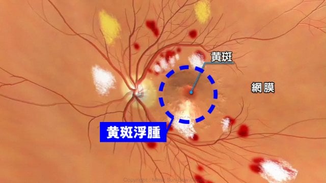 糖尿病糖尿病網膜症イラスト5