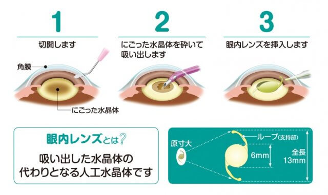白内障手術の流れ