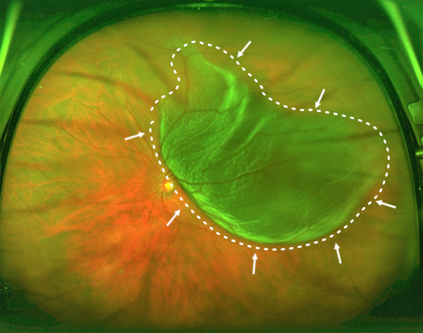 網膜剥離のオプトス画像