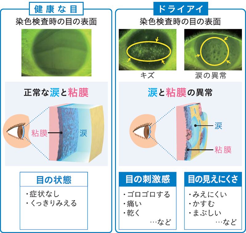 健康な目とドライアイの違い