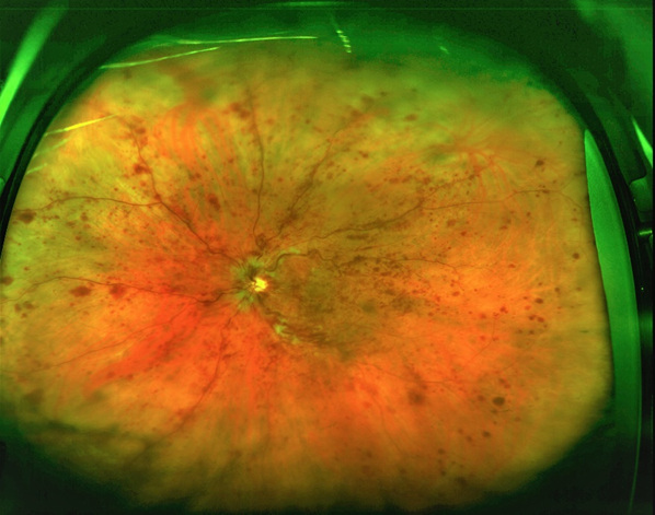 網膜中心静脈閉塞症のオプトス画像