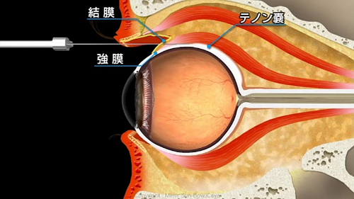 テノン嚢下注射