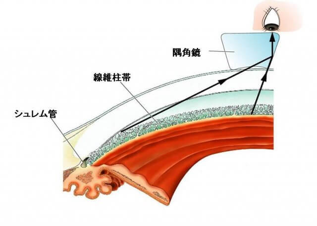 隅角検査