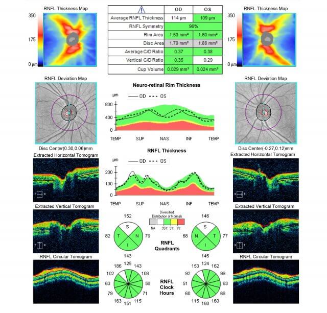 視神経のOCT解析画像