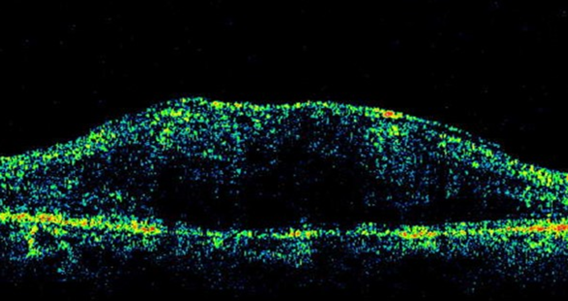黄斑前膜のOCT画像（矢印部分の断面）