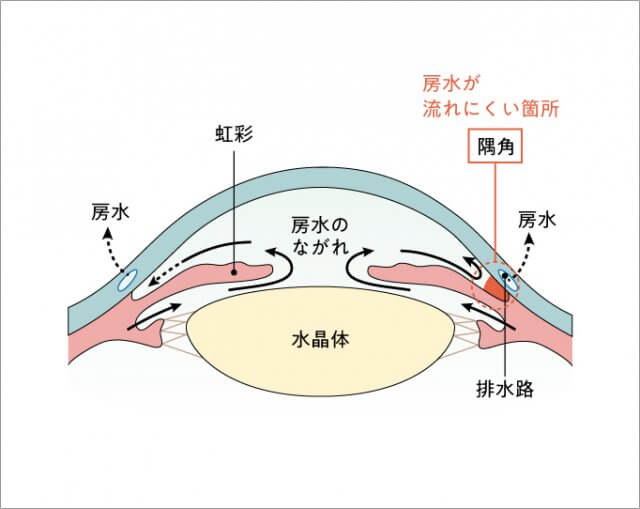 圧 原因 眼 高い 眼圧あれこれ