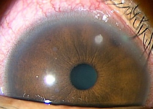 【眼科医が教える】角膜潰瘍！コンタクトレンズで失明！