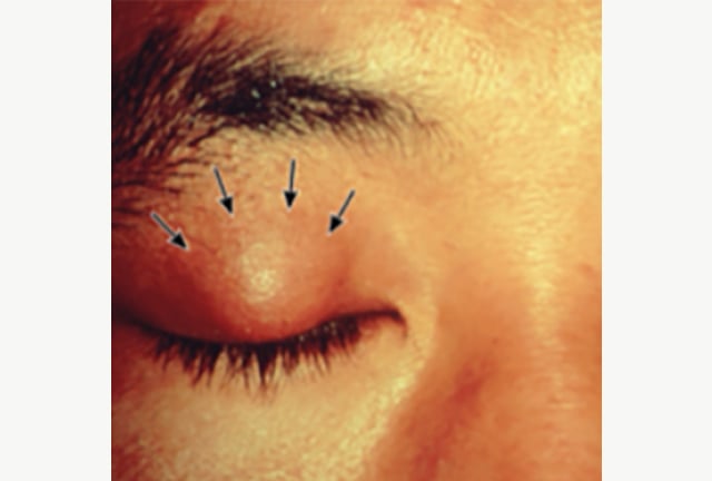 stye-img